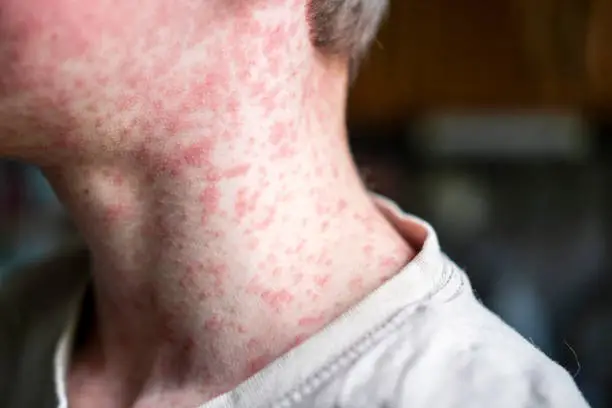 Measles Outbreaks Surge Worldwide: Families Traveling This Summer Warned to Ensure Vaccinations Are Up to Date